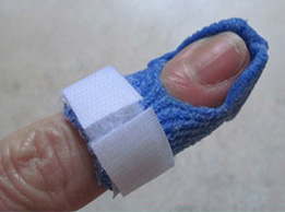 The Mallet Finger Orthosis 8